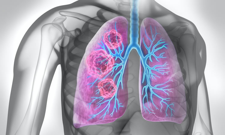 asbestos lung cancer