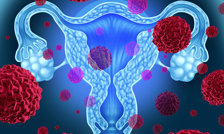 ovarian cancer